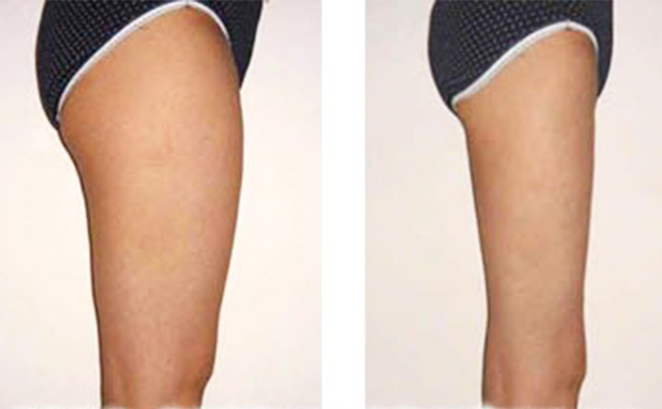 大腿吸脂會(huì)損壞肌肉嗎？