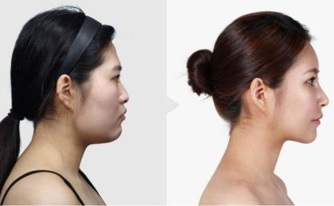 隆鼻手術(shù)多久恢復(fù)自然？