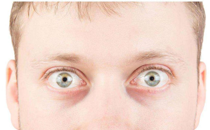 眼球突出是什么原因引起的？眼球突出如何矯正？