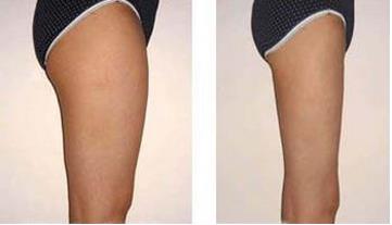 臀部抽脂會(huì)留疤嗎？