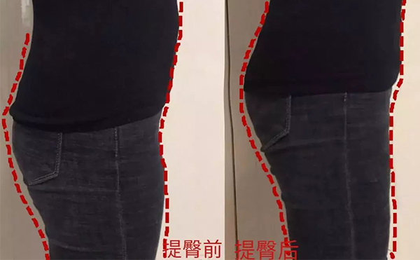 什么是提臀術(shù)?提臀術(shù)有什么優(yōu)勢?
