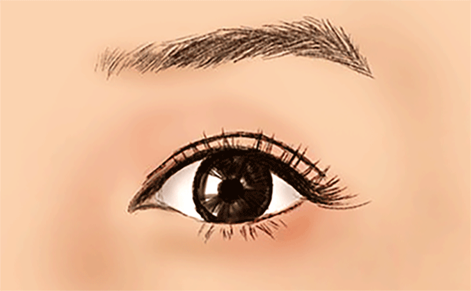 無(wú)痕開(kāi)眼角的價(jià)格是多少？