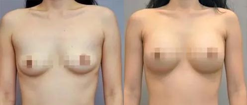 假體隆胸手術效果對比圖2