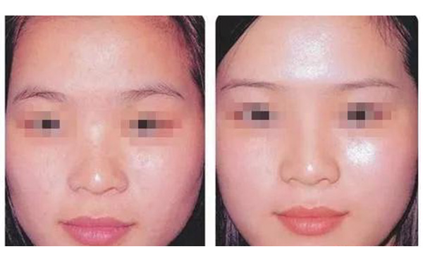 水光注射疼不疼？