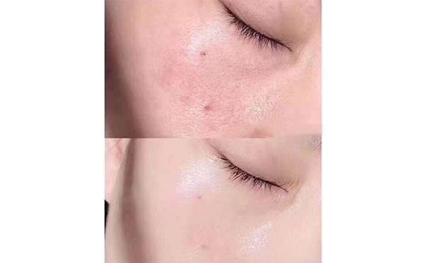 無針水光針安全嗎？