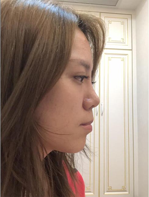 肋軟骨鼻綜合案例:術(shù)后效果