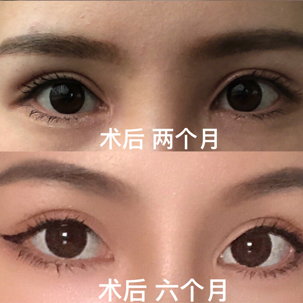 北京煤醫(yī)西壩河醫(yī)療美容的梁偉中醫(yī)生割雙眼皮案例