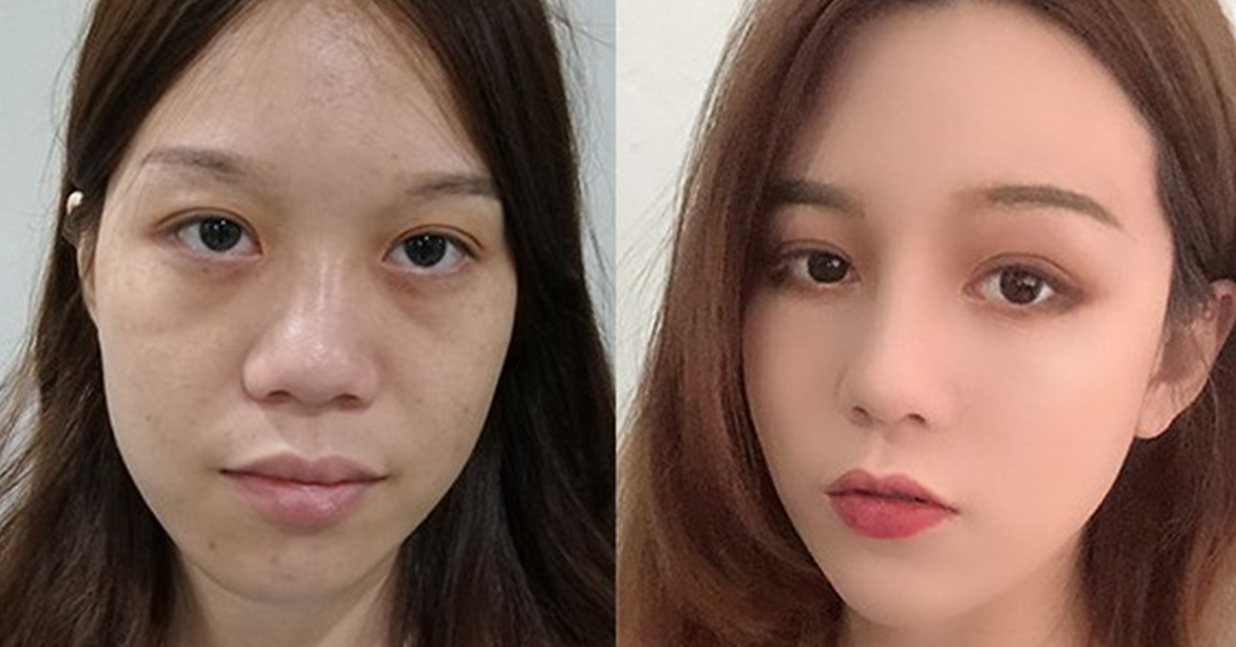 脂肪填充手術(shù)效果對比2