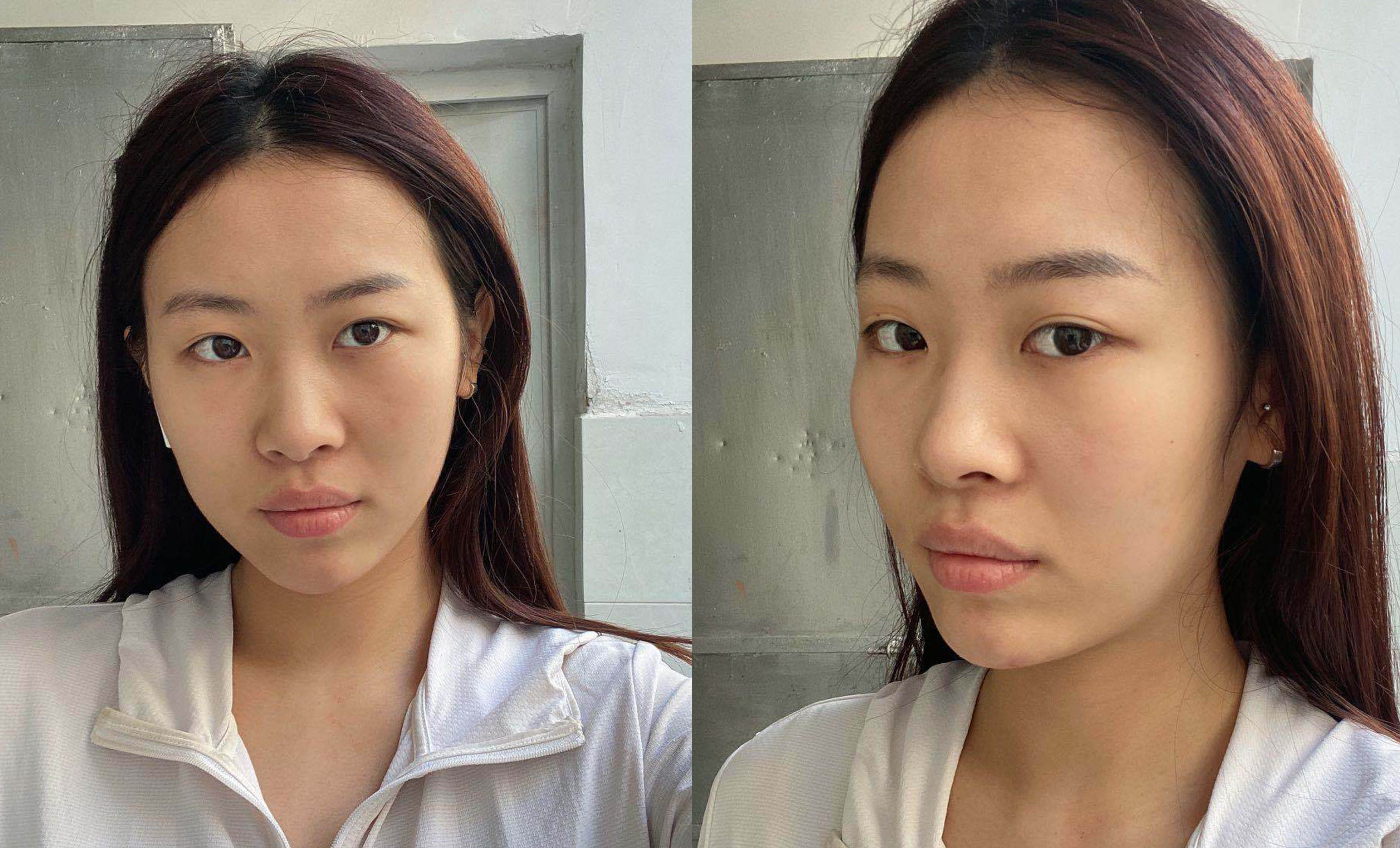 寧波藝星熱瑪吉術后一年效果反饋2