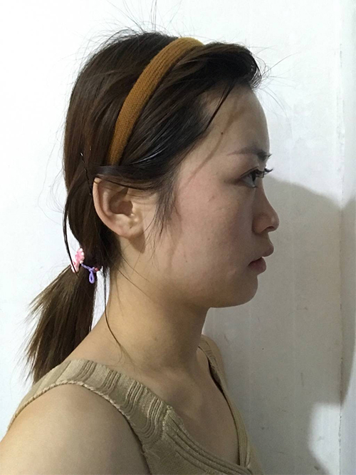 天津伊美爾超肋鼻綜合案例大賞