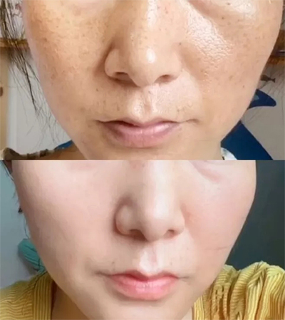 九江協(xié)和光子嫩膚--素顏也扛打的秘密