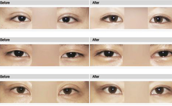 雙眼皮手術(shù)失敗如何修復(fù)呢?需要多長(zhǎng)時(shí)間?