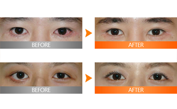 埋線雙眼皮失敗該如何修復(fù)？多久修復(fù)好？