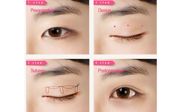 韓式三點(diǎn)雙眼皮的優(yōu)點(diǎn)是什么?術(shù)后怎么避免不對稱?