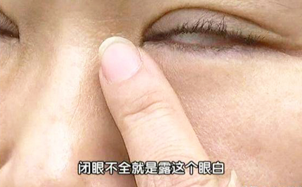 割雙眼皮后眼睛為什么閉不上?怎么修復?