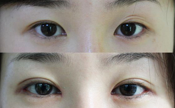 哪個季節(jié)做雙眼皮好?術(shù)后有什么需要注意的?
