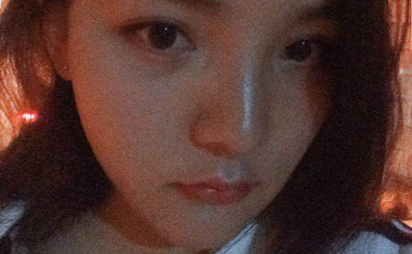 石家莊藍(lán)山杜建龍醫(yī)生下頜角整容手術(shù)案例術(shù)后兩個月