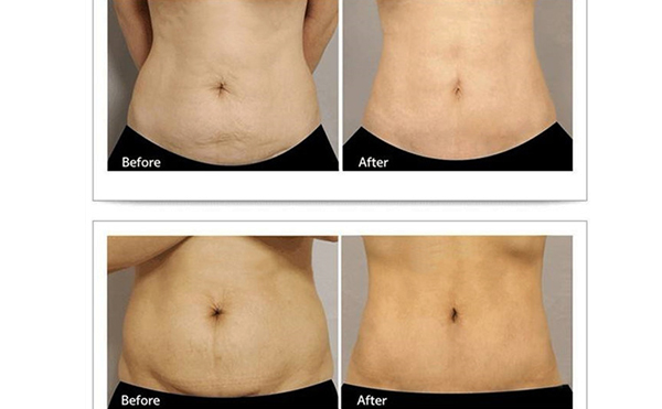 腹壁成型術(shù)會(huì)留疤嗎？