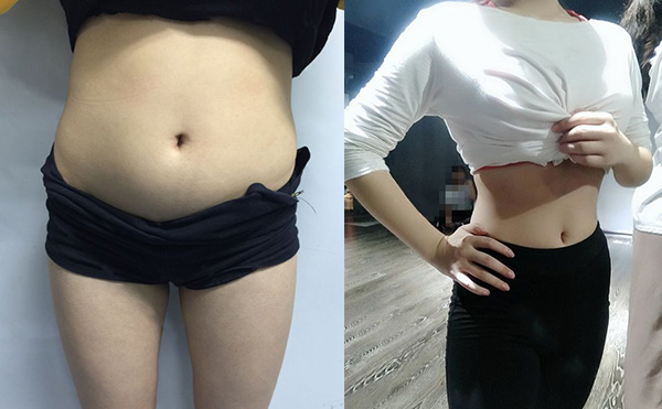 環(huán)吸抽脂有什么優(yōu)勢(shì)？