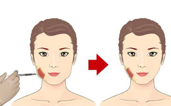 一般瘦臉針打幾針才有效果