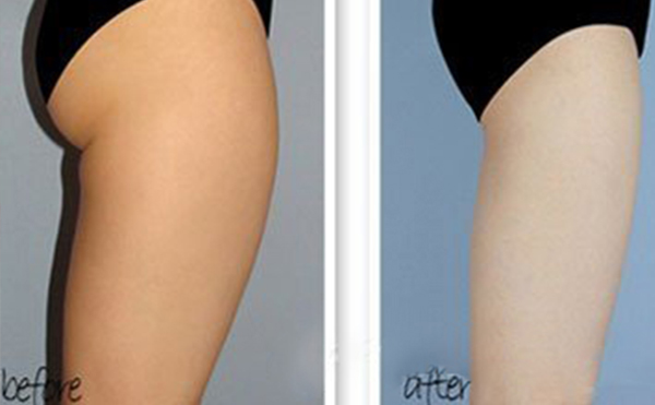 哪些人適合做臀部抽脂？