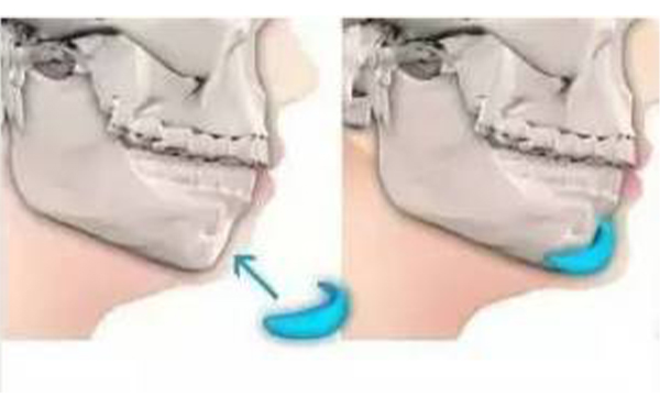 假體墊下巴術后怎樣護理?術后效果不滿意可以取出假體嗎?