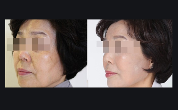 電波拉皮適合哪些人？