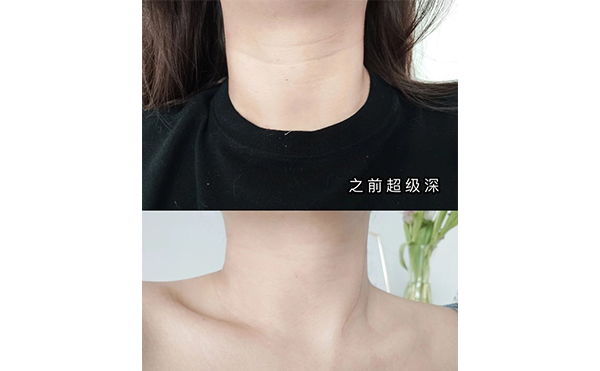 激光去頸紋適合哪些人？