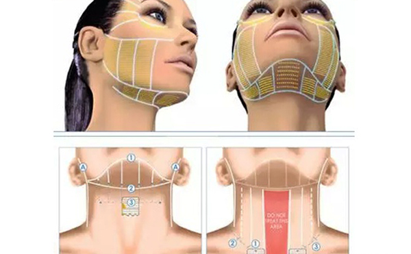 超聲刀怎么祛除頸紋？