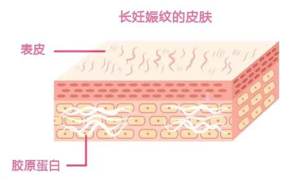 妊娠紋是怎么形成的？