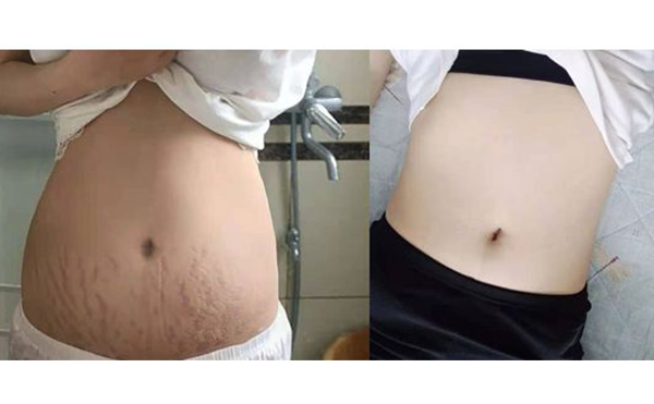 激光可以去除妊娠紋嗎？