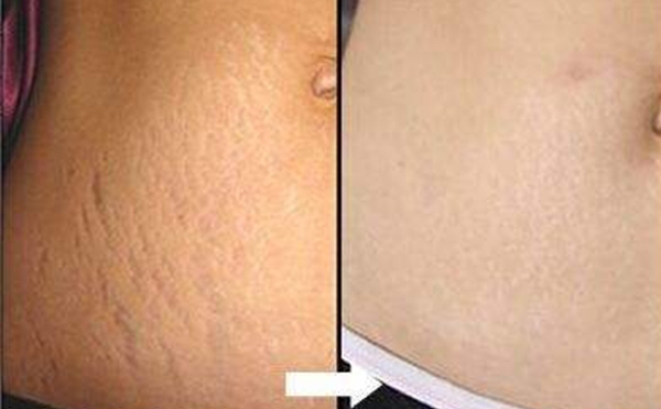 激光去妊娠紋幾次見(jiàn)效？