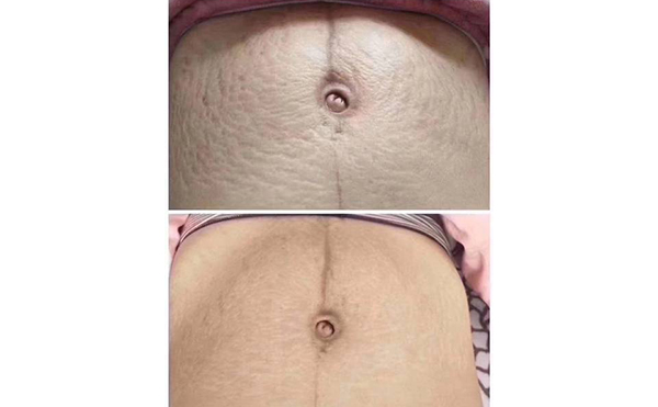 激光去妊辰紋多少錢？