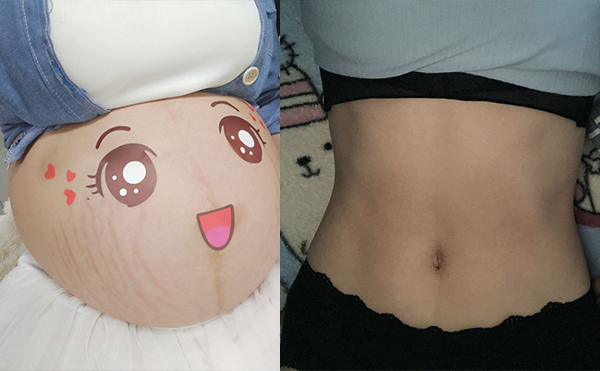 電波拉皮去除妊娠紋效果怎么樣？