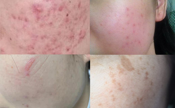 光子嫩膚安全嗎？