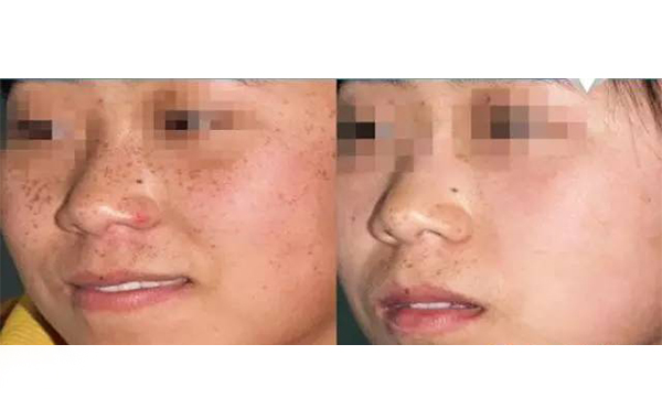 彩光嫩膚的效果怎么樣？