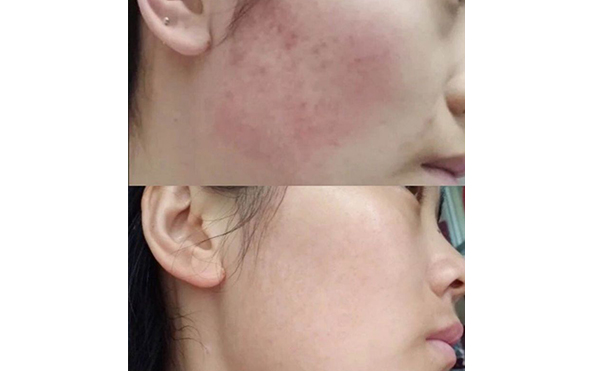 彩光嫩膚會(huì)讓皮膚變薄嗎？