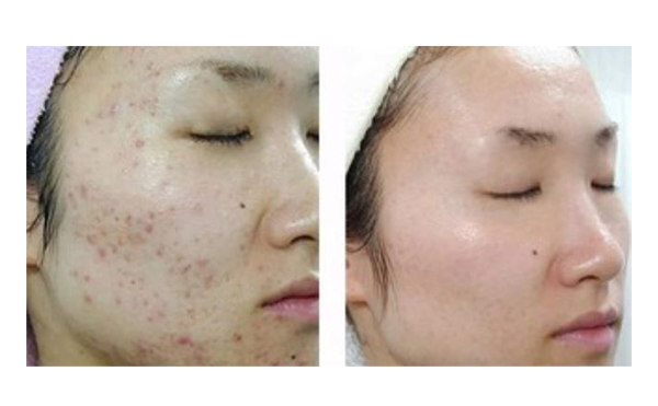 果酸煥膚多久做一次？