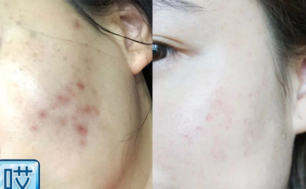 激光美白能安全嗎？