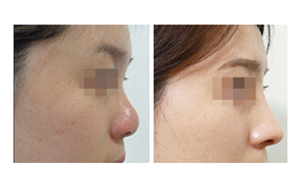 美白針和激光美白怎么選？