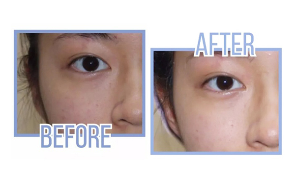 激光美白做幾次有效果？