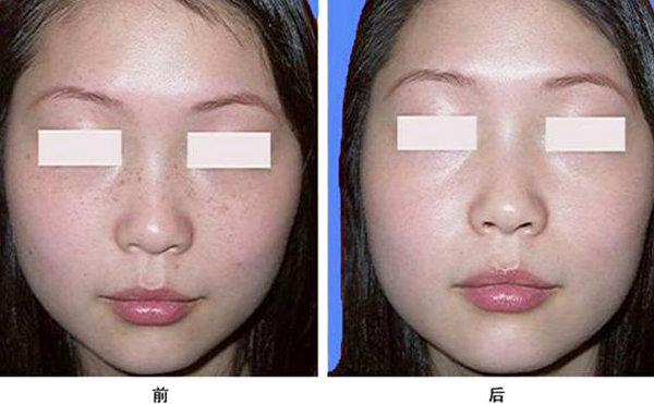 激光祛斑真的能去干凈嗎？