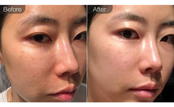 e光嫩膚是什么？