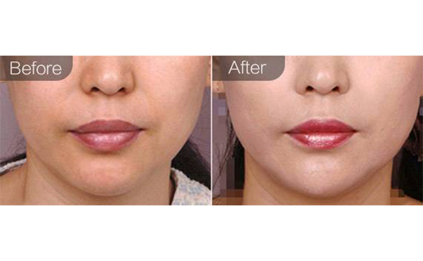 e光嫩膚有什么優(yōu)勢？