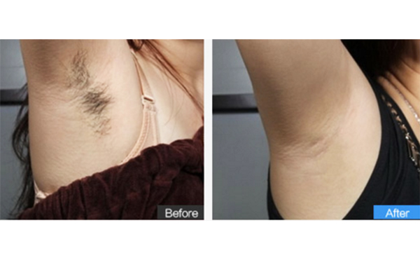 激光脫腋毛后多久能見效？
