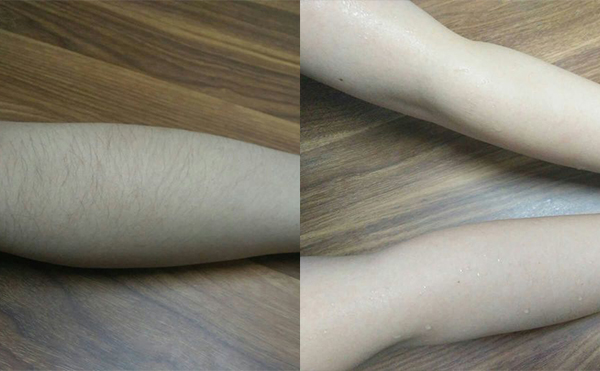 冰點(diǎn)手臂脫毛會(huì)傷害皮膚嗎？
