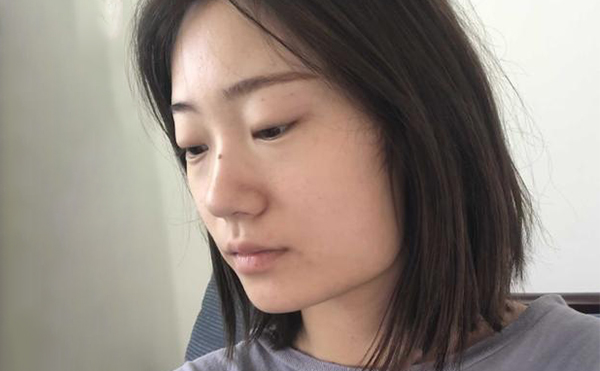 下頜角整形適宜人群有哪些?