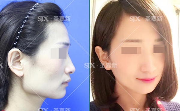 下頜角整形后皮膚是否會松弛？