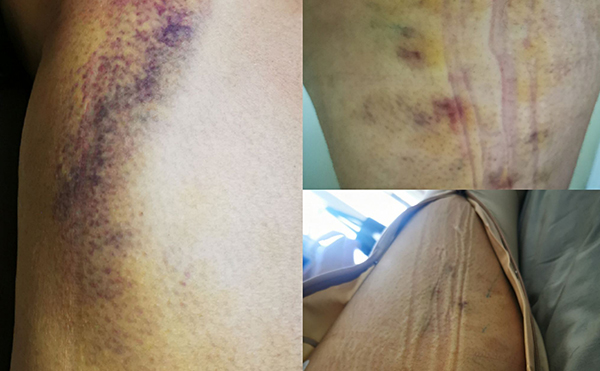 打瘦腿針有什么后遺癥嗎？