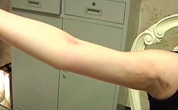 手臂吸脂有副作用嗎？